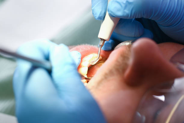 Best Broken or Chipped Tooth Repair in Moline, IL