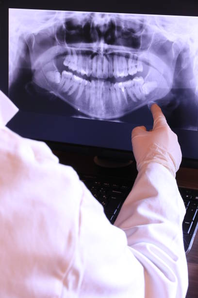 Best Knocked-Out Tooth (Avulsed Tooth) Treatment in Moline, IL
